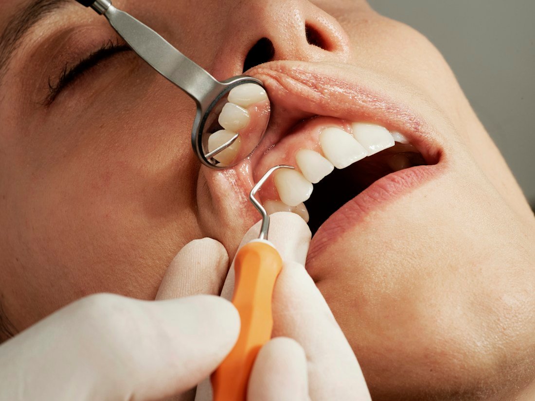 Teeth Cleaning dental care